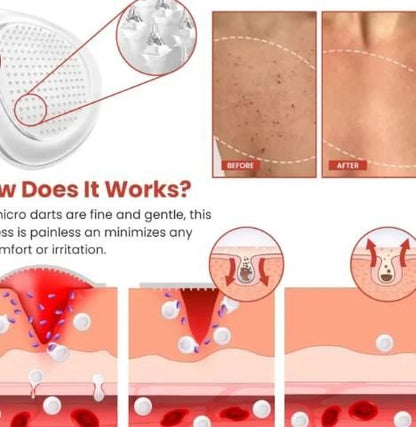 Derma Smooth Skin Tag Removal Patches (Pack Of 10)