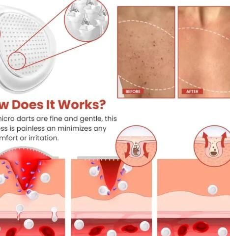 Derma Smooth Skin Tag Removal Patches (Pack Of 10)